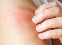 皮膚のかゆみの隠れた原因を明らかにする:乾燥を超えて 