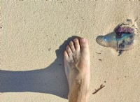 クラゲに刺されたときの応急処置:海水浴客のための総合ガイド 