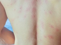 フナムシとビーチの皮膚の炎症：原因、治療、予防 